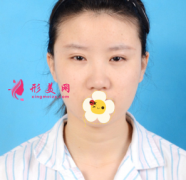 上海美聯(lián)臣整形醫(yī)院眼綜合+鼻綜合案例分享