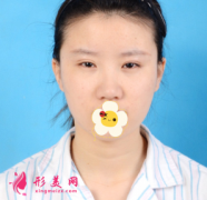 上海美聯(lián)臣整形醫(yī)院眼綜合+鼻綜合案例分享