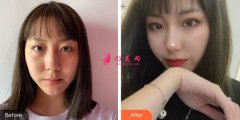 陸軍總院隆鼻怎么樣？真人術(shù)后效果分享