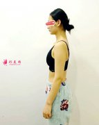 北京純脂整形醫(yī)院做豐胸整形，讓我找回了自信