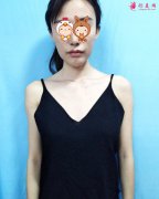 成都圣丹福整形醫(yī)院做假體隆胸，讓我擁有飽滿挺拔的胸部