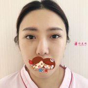 北京煤炭總醫(yī)院整形歪鼻修復案例，歪鼻洗碗妹到精致美女的逆襲