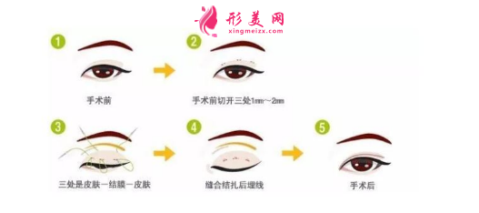 全切雙眼皮感染的表現(xiàn)