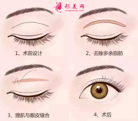 全切雙眼皮感染的表現(xiàn)