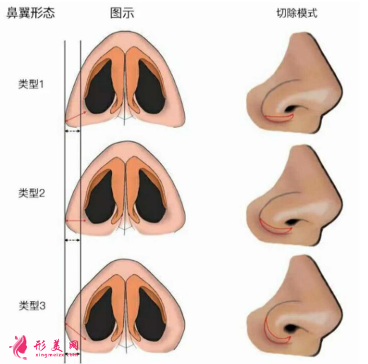 鼻翼縮小整形術(shù)