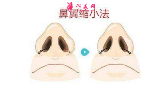 鼻翼縮小整形術(shù)