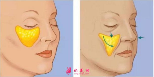 自體脂肪填充淚溝