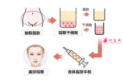 自體脂肪填充淚溝有沒有恢復期？術前必看！