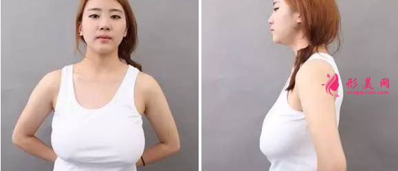 巨乳縮小術(shù)后多久能恢復(fù)
