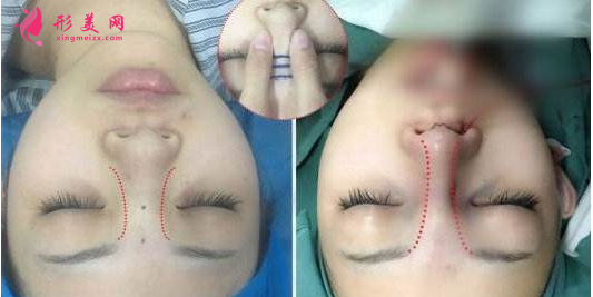 怎樣墊高鼻梁