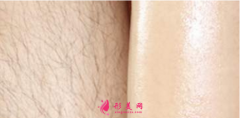 如何能永久脫毛？冰點(diǎn)脫毛冰冰涼涼效果很不錯