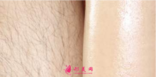 如何能永久脫毛