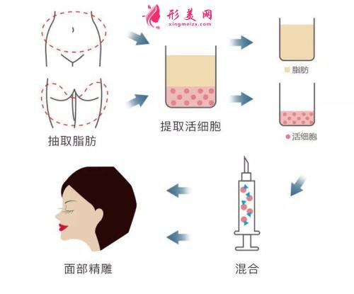 自體脂肪面部填充術(shù)前準備