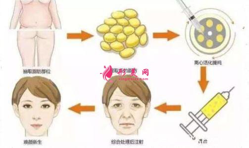 自體脂肪面部填充術(shù)前準備