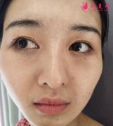 杭州華山連天美整形醫(yī)院水光針前后對比圖分享