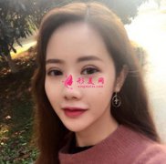 重慶軍科整形醫(yī)院雙眼皮術(shù)后對(duì)比圖分享，30天恢復(fù)經(jīng)驗(yàn)