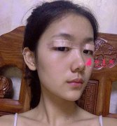 成都武侯蓉美和諧醫(yī)療整形雙眼皮+隆鼻案例對比圖分享