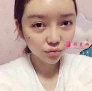 武漢妍美整形面部線雕提升靠譜嗎？親身經(jīng)歷分享及醫(yī)院介紹