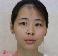 上海九院雙眼皮修復(fù)效果圖好嗎？手術(shù)60天前后對比圖一覽