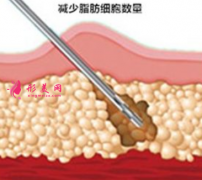 吸脂減肥前要做什么準(zhǔn)備