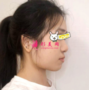 上海九院下頜角磨骨案例，秒變小臉太好看了