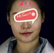 上海首爾麗格整形醫(yī)院下頜角磨骨案例 顏值在線 人生開掛