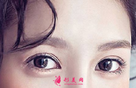 做雙眼皮手術(shù)痛不痛