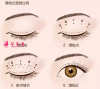 埋線雙眼皮術(shù)后要怎樣護(hù)理？
