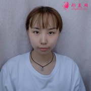 廣州南方醫(yī)院雙眼皮案例術后分享