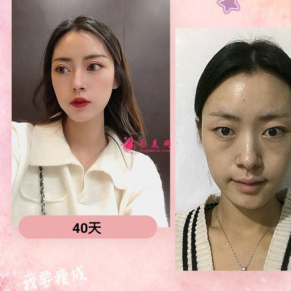 給大家安利下我在重慶藝星割的雙眼皮恢復(fù)過程