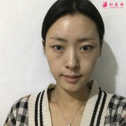 給大家安利下我在重慶藝星割的雙眼皮恢復(fù)過程