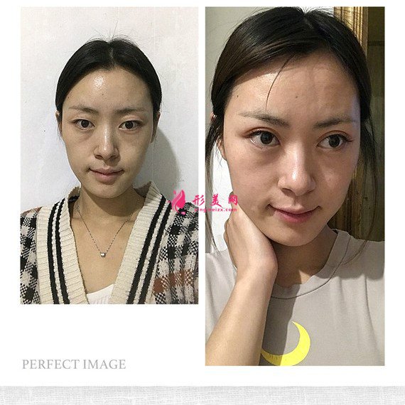 給大家安利下我在重慶藝星割的雙眼皮恢復(fù)過程