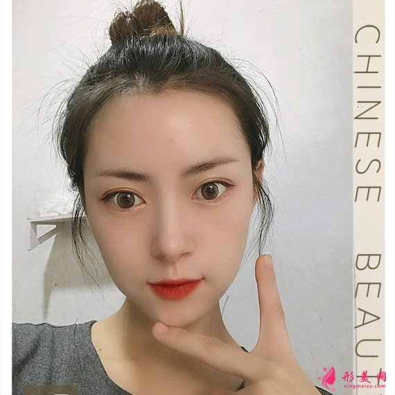給大家安利下我在重慶藝星割的雙眼皮恢復(fù)過程