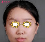 上海伊萊美醫(yī)療美容醫(yī)院怎么樣？隆鼻+面部吸脂后案例分享