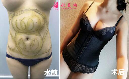 腰腹吸脂減肥手術(shù)案例分享，前后對(duì)比效果圖片來襲！