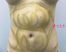 腰腹吸脂減肥手術(shù)案例分享，前后對(duì)比效果圖片來襲！