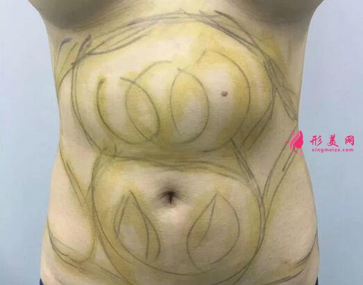腰腹吸脂減肥手術(shù)案例分享，前后對(duì)比效果圖片來襲！