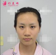 上海美聯(lián)臣怎么樣?【鼻頭縮窄108天驚人案例】這樣的效果我很滿意