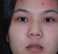北京劉彥軍韓式分段隆鼻案例：1-15天的變化對(duì)比圖
