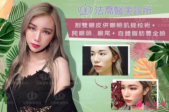 長沙美之峰謝燦雙眼皮案例在這，看不看隨你了~