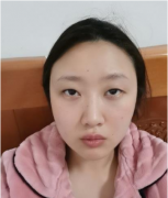 北京黃寺邵禎雙眼皮案例分享，改造我的單眼皮小眼睛！