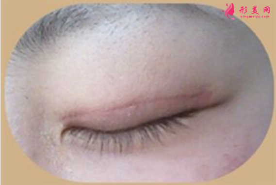 雙眼皮術(shù)后疤痕增生了還能消退嗎