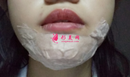 假體墊下巴前要做什么準(zhǔn)備