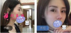 四川軍大整形鐘正強醫(yī)生鼻綜合整形案例 隆鼻術后分享