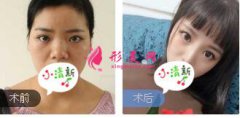 四川軍大整形鐘正強醫(yī)生鼻綜合整形案例 隆鼻前后對比