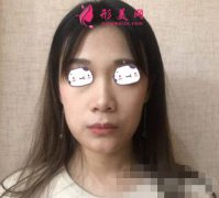 上海復(fù)旦大學(xué)附屬華山醫(yī)院隆鼻案例 隆鼻價(jià)格