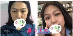 成都軍建醫(yī)院楊俊醫(yī)生膨體隆鼻案例 納米隆鼻