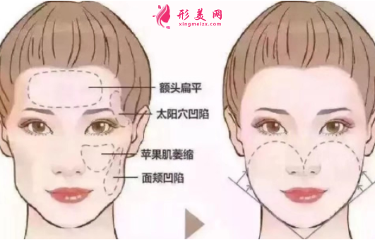 自體脂肪填充臉部恢復(fù)時(shí)間長(zhǎng)不長(zhǎng)