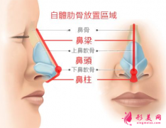 肋軟骨隆鼻效果能管多久？