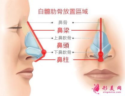 肋軟骨隆鼻效果能管多久